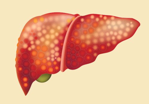 Fatty liver