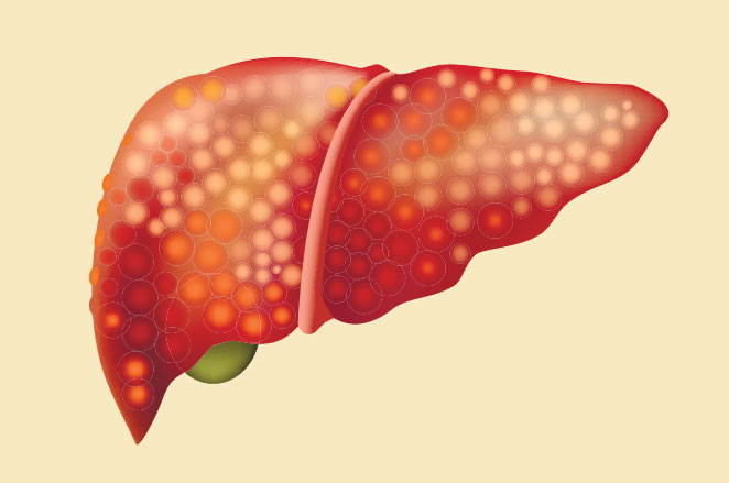 Fatty liver