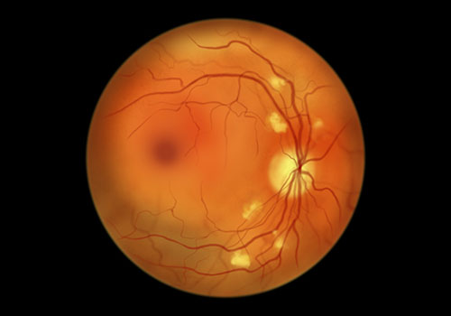 Diabetic retinopathy