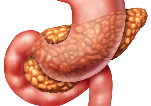 Fatty pancreas