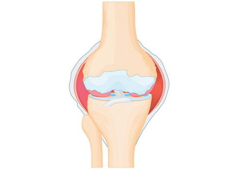 Swollen joint