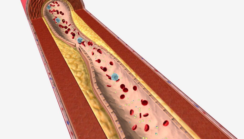 Hypertriglyceridaemia