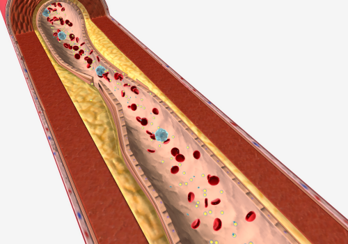 Hypertriglyceridaemia