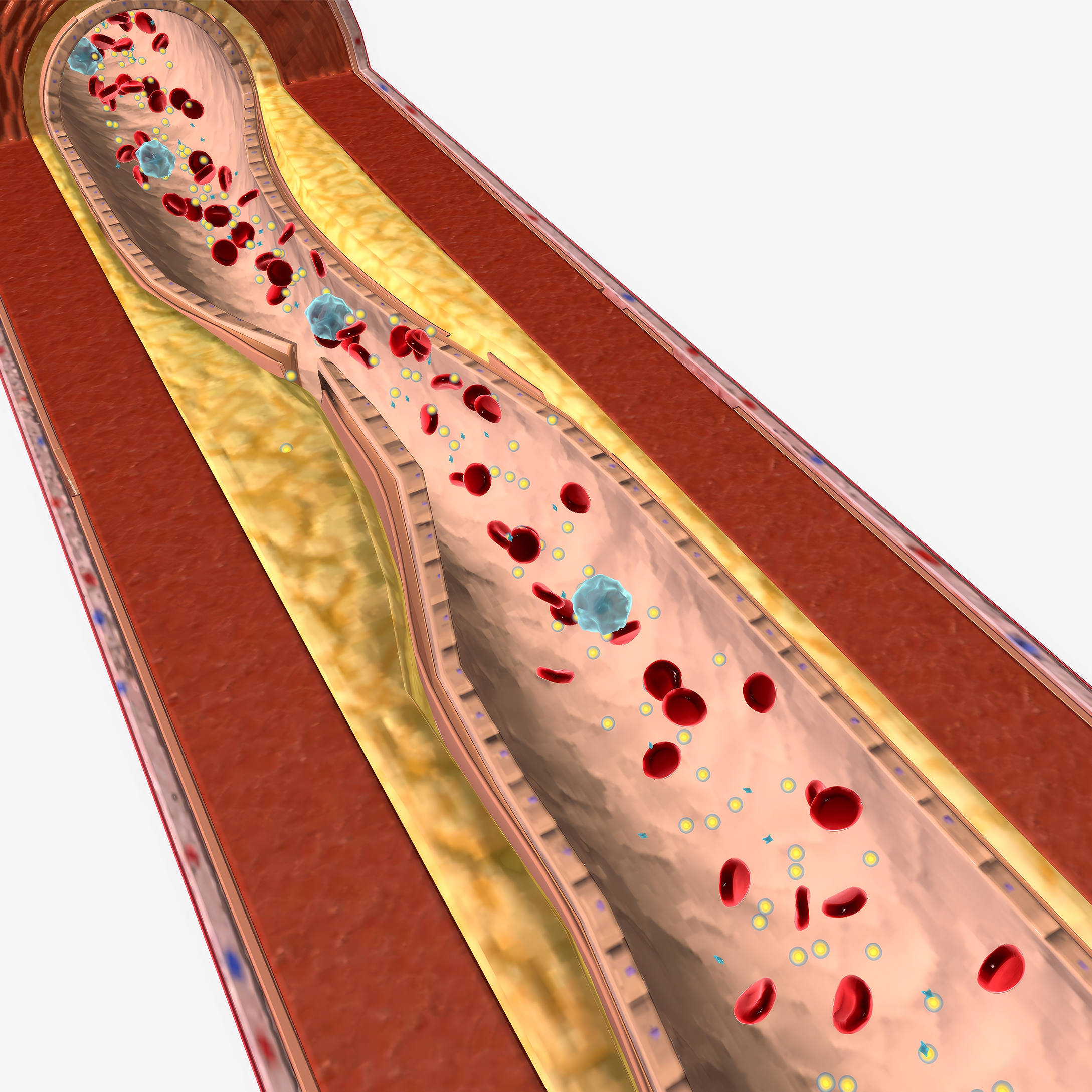Hypertriglyceridaemia