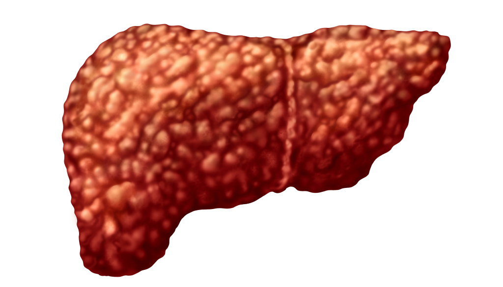 Steatotic liver disease
