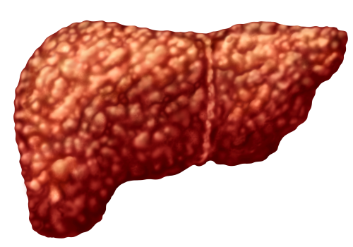 Steatotic liver disease