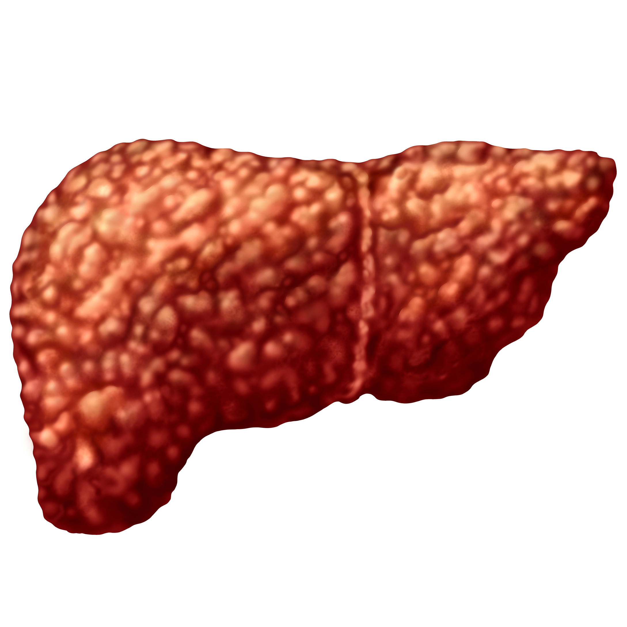 steatotic liver disease
