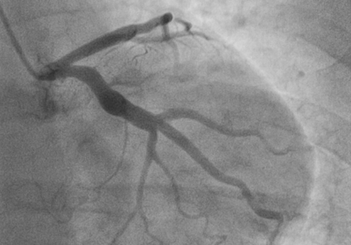 Coronary angiography