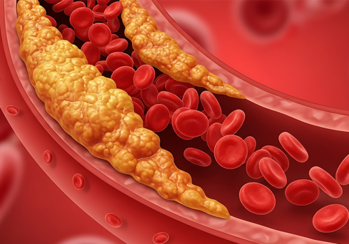 Artery Blockage / Atherosclerosis