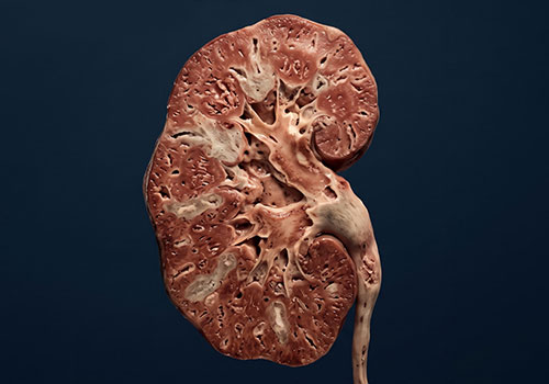 CKD